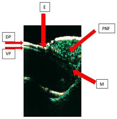 High-Frequency Ultrasonography and Evaporimetry in Non-invasive Evaluation of the Nail Unit